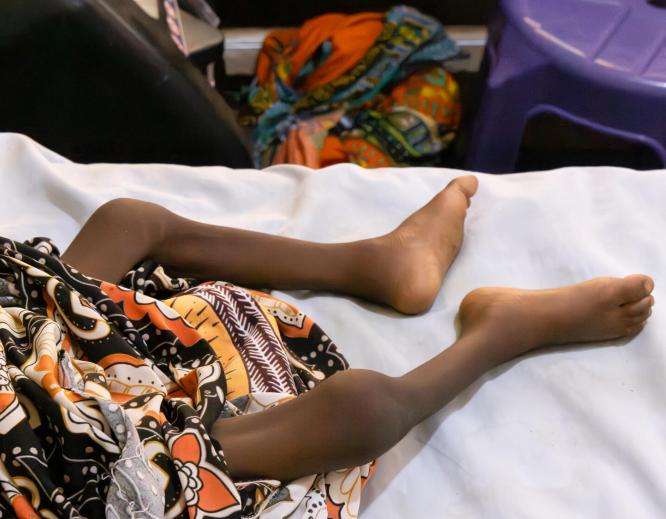 The legs of a malnourished child on a hospital bed in Nigeria.