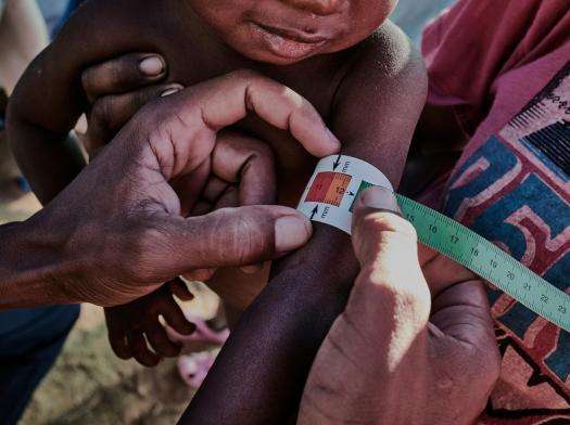 An MSF staff member measures the size of a child's arm in Madagascar, during a period of severe malnutrition.
