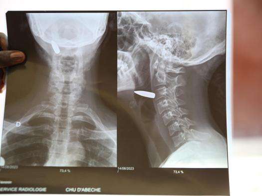 X-ray of bullet lodged in neck of woman fleeing conflict in Sudan